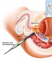 Grundläggande principer för diagnos och behandling av akut prostatit